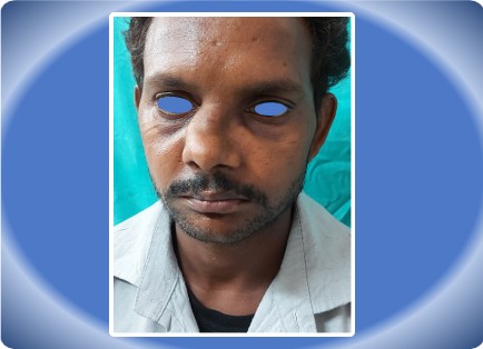 NASAL FRACTURE